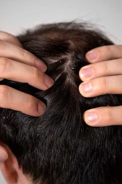 Overview of hair loss